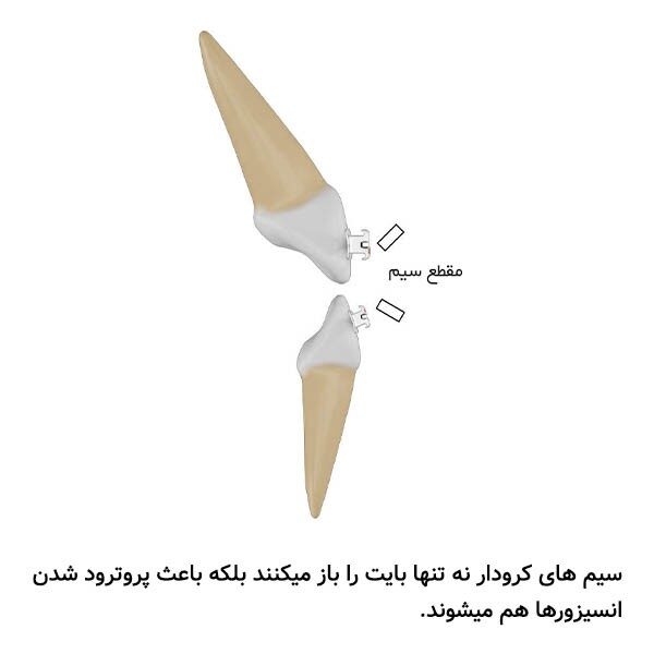 سیم سوپرالاستیک کرودار بیضی چینی